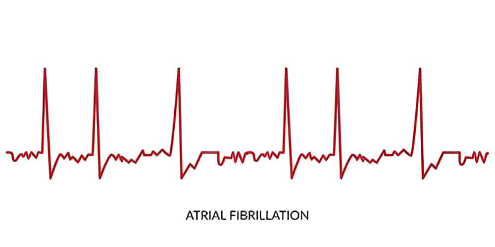Atrial Fibrillation
